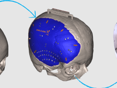 Implantes cranio-maxilo-faciais personalizados - PSI